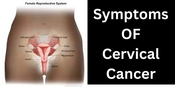 Symptoms OF Cervical Cancer