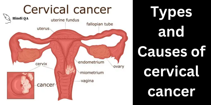 Types and Causes of cervical cancer